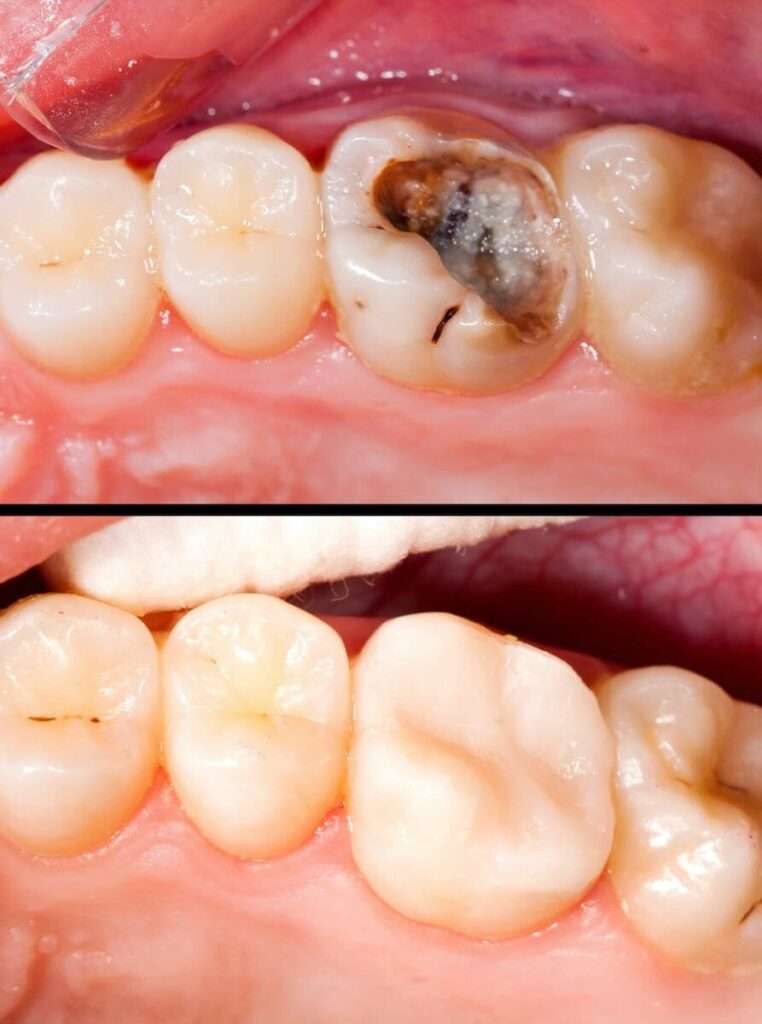 DECAY TOOTH