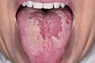 TONGUE INFECTION