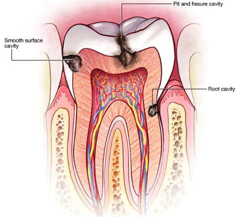 cavity in teeth, tooth cavity treatment, tooth cavity pain, tooth cavity pain relief, tooth cavity treatment at home, tooth cavity symptoms, tooth cavity pain home remedy, tooth cavity pain home remedy, tooth pain treatment, cavities tooth decay, tooth cavity treatment, how to stop tooth decay